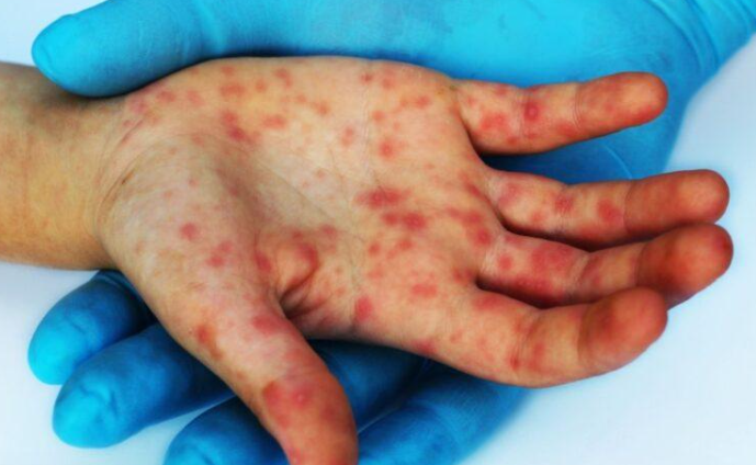 Muere primer mexicano por sarampión en 2026; era de Michoacán